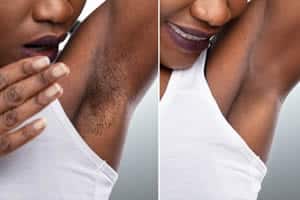 Underarm hair removal