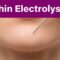Chin Hair Electrolysis: How Many Sessions Will It Take?