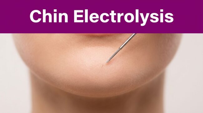 featured-chin-hair-electrolysis-how-many-sessions-will-it-t-b1b716c7 Chin Hair Electrolysis: How Many Sessions Will It Take?
