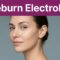 Sideburn Electrolysis for Women: What I Tell Clients