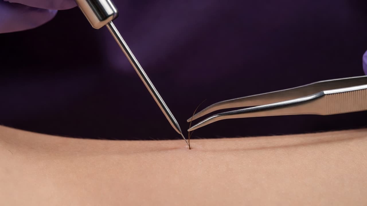 A slender metal electrolysis probe approaches a single hair follicle on smooth skin. The clinical setting features professional instruments and soft, diffused lighting set against a deep purple background.